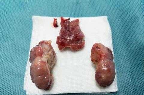 腺样体切除