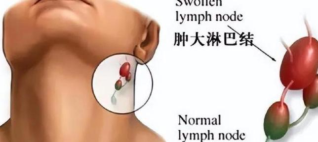 淋巴腺体是哪个部位